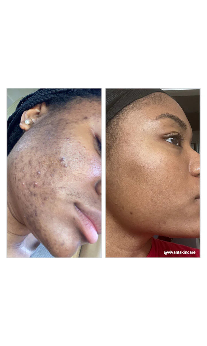 Vivant 8% Mandelic Acid 3 in 1 Serum