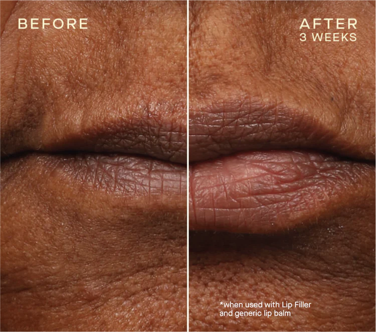 Ourself Lip Filler