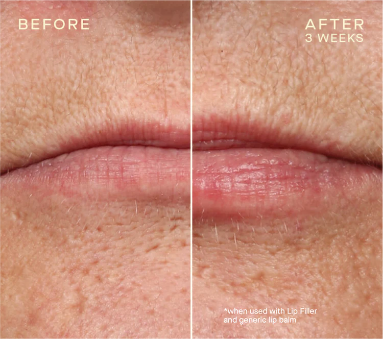 Ourself Lip Filler